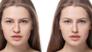 Rinoplastia e assimetria nasal: conheça técnicas avançadas para resolver irregularidades e melhorar a estética facial e a saúde respiratória. 